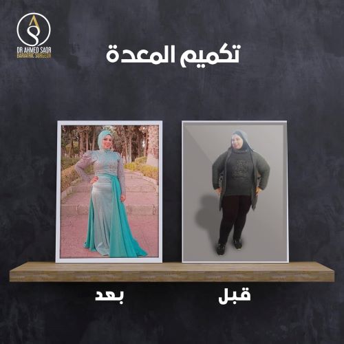 جراحات السمنة بمصر